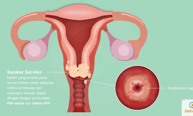 Kanker Serviks: Ancaman Tersembunyi Yang Bisa Dicegah